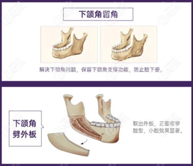 磨截联合下颌角整形会留角