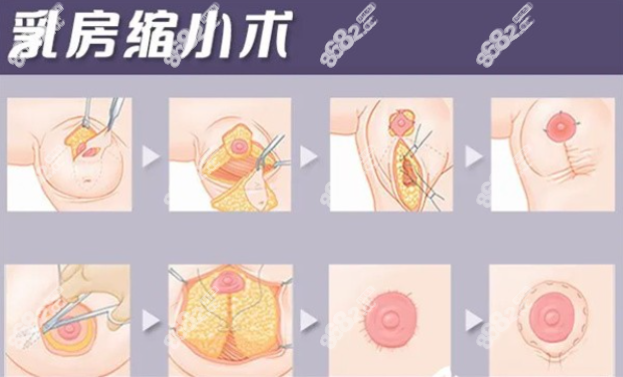 穆乳房缩小手术图示