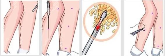 小腿吸脂手术示意图