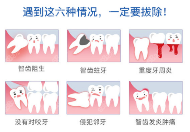 杭州拔牙一般多少钱一颗