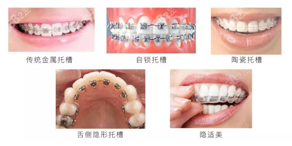 牙齿矫正器的不同类型