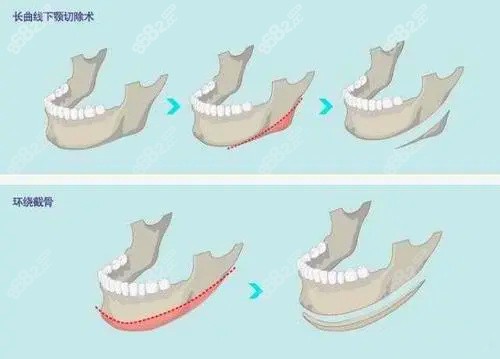 杭州高俊明做下頜角手術(shù)技術(shù)好