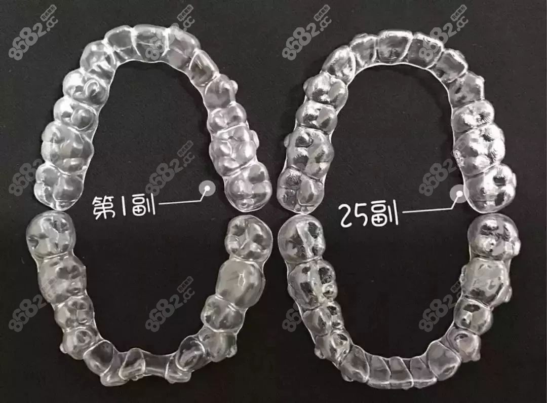 隐形牙套矫正牙齿前后总共要花多少钱？内含隐形牙套、3D扫描、保持器、美白牙齿等价位 - 咕噜美国通 (Guruin.com)