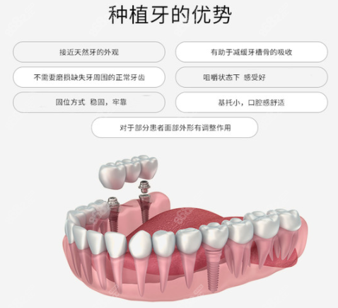 <!--<i data=20240705-sp></i>-->口腔做种植牙的优势