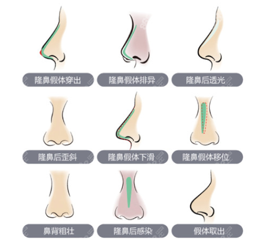 周柯修复鼻收费贵不