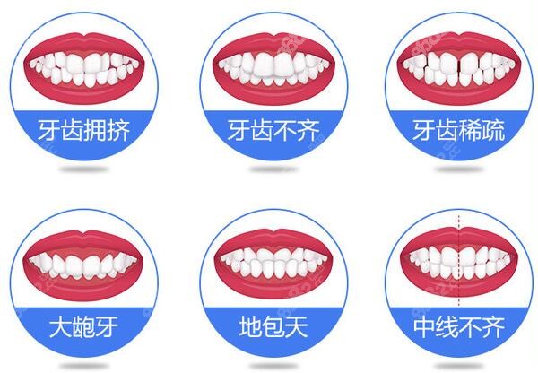 不同种类的错颌症状