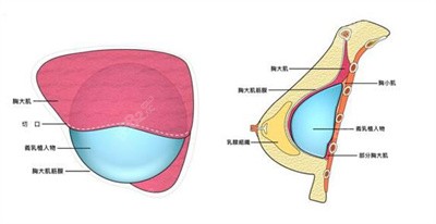 孙森医生在隆胸方面的技术优势5