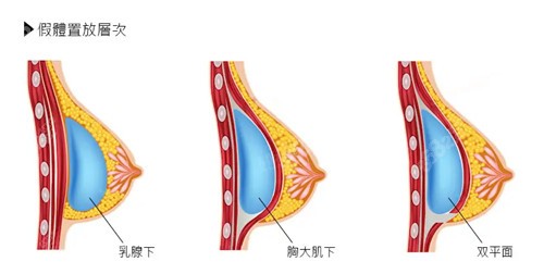 长沙星雅整形丰胸