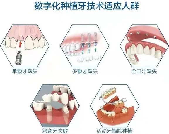 苏州全口种植牙多少钱