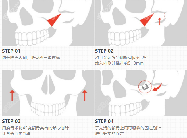 女神整形颧骨磨骨手术图示