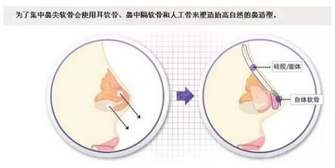武漢中翰整形隆鼻價格表公布.jpg