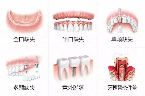 上海伊人口腔种植牙价格要结合牙缺失情况