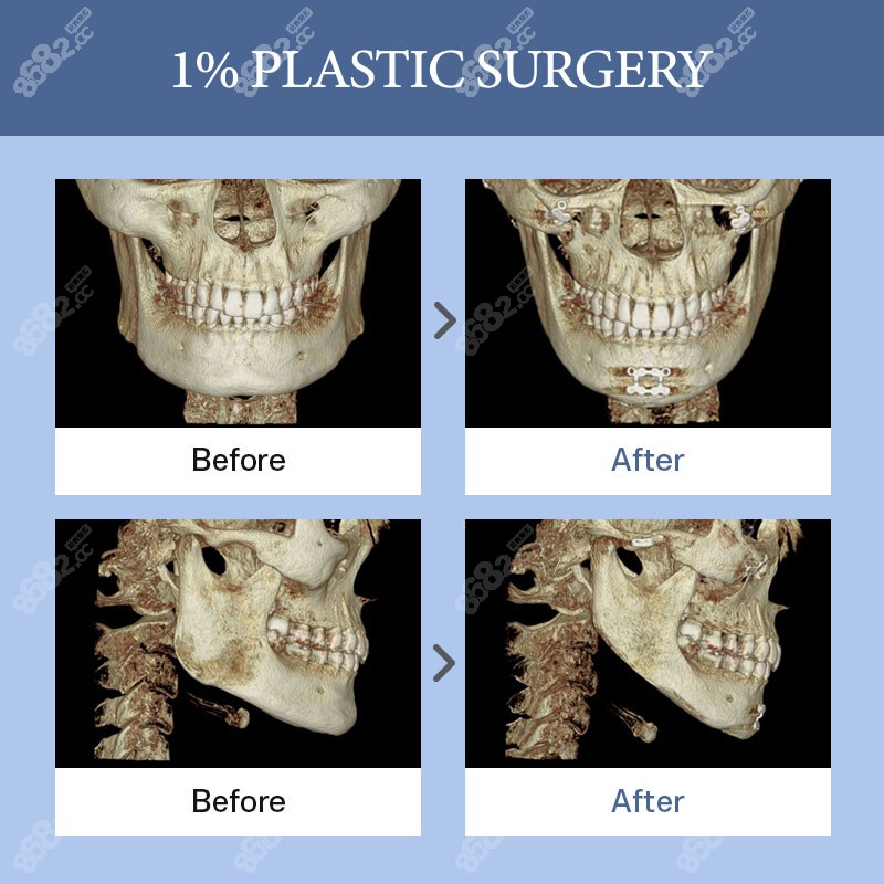 韩国1%整形外科医院下颌角、下巴整形CT图