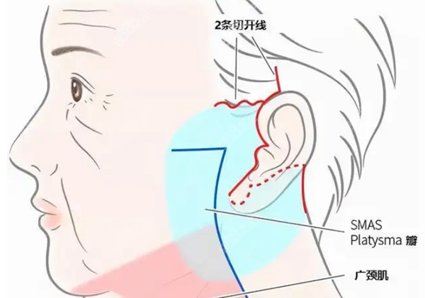 做大拉皮手术多少钱