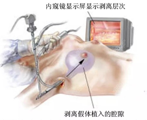 成都内窥镜隆胸医院