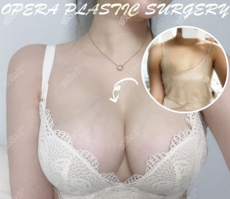 韓國(guó)歐佩拉隆胸實(shí)例圖 韓國(guó)歐佩拉隆胸實(shí)例圖