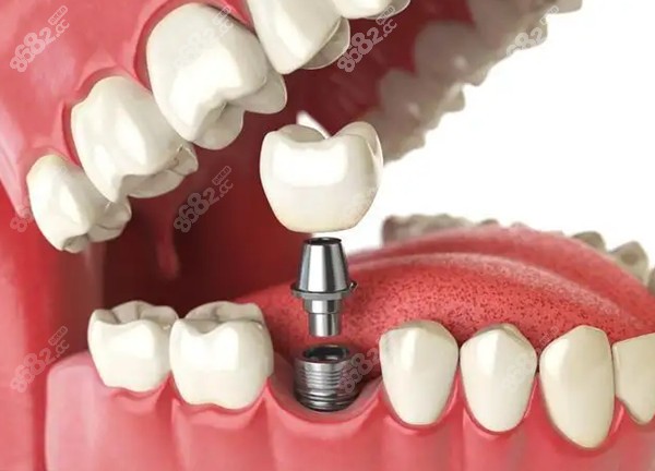 濟南瑞泰口腔醫(yī)院種植牙收費標準