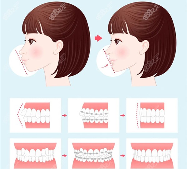 龅牙矫正前后对比