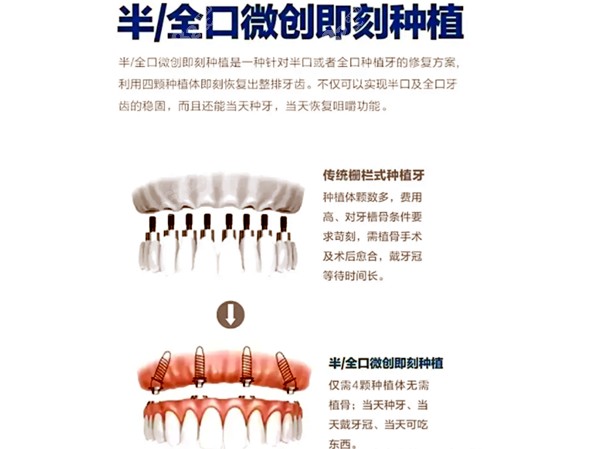 半口,全口微创即刻种植和普通种植技术的对比