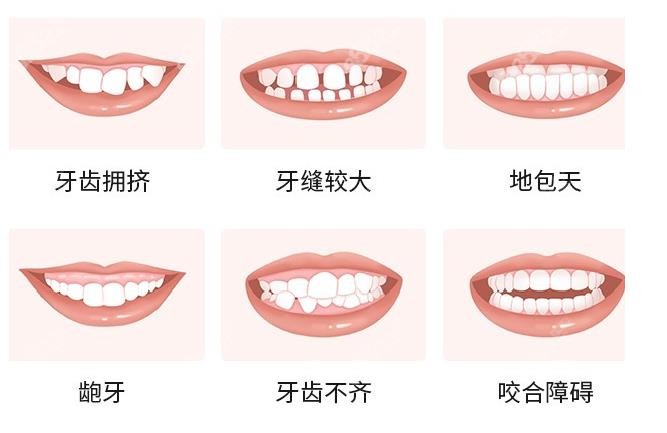 日照瑞贝口腔医院8682网，适合牙齿矫正症状