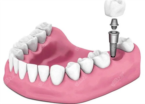 拜博口腔种植牙示意图