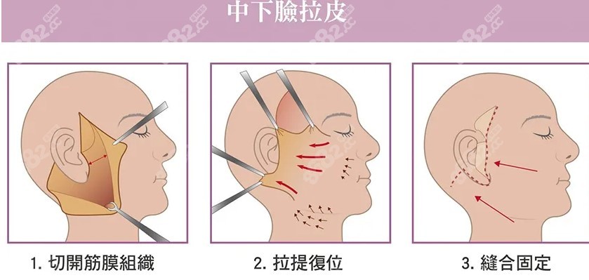 中下面部拉皮手术全过程图