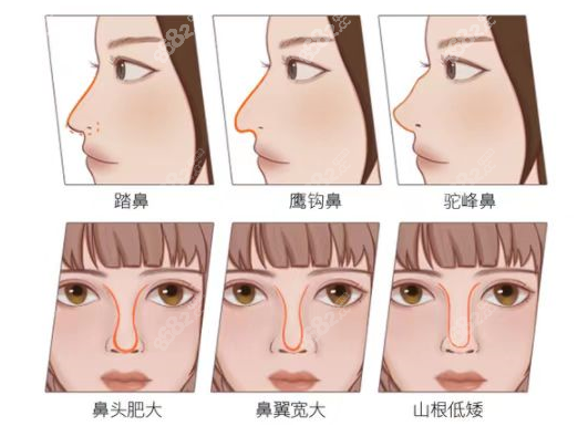 南宁爱思特的王楷医生做隆鼻的类型图