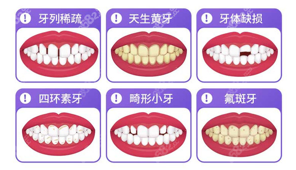 南宁柏乐口腔做牙贴面的牙齿类型