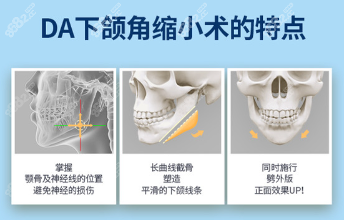 da医院下颌角手术优势