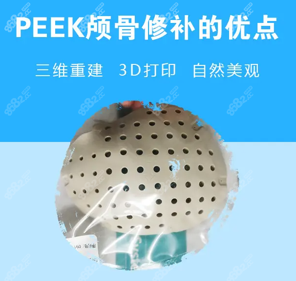 上海时光peek颅骨修补术的优势