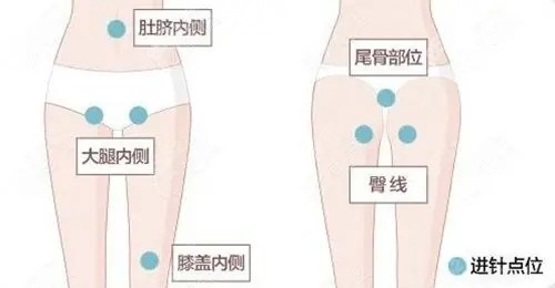 吸脂瘦大腿