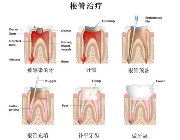 网传"大家要扛住尽量不要做根管治疗"不可信