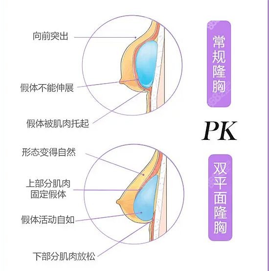 长沙假体隆胸医生推荐