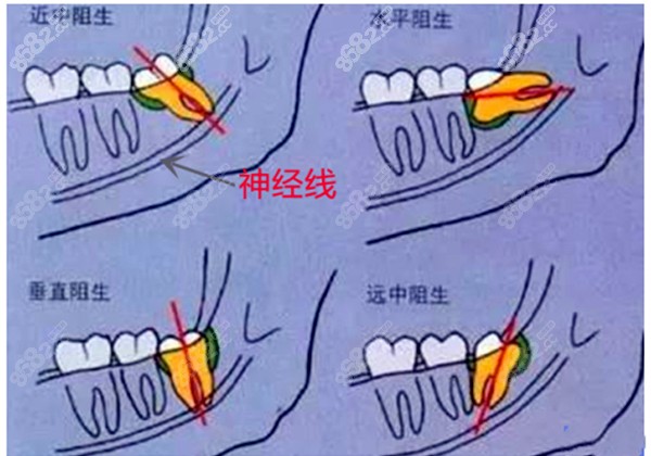 智齿生长位置图