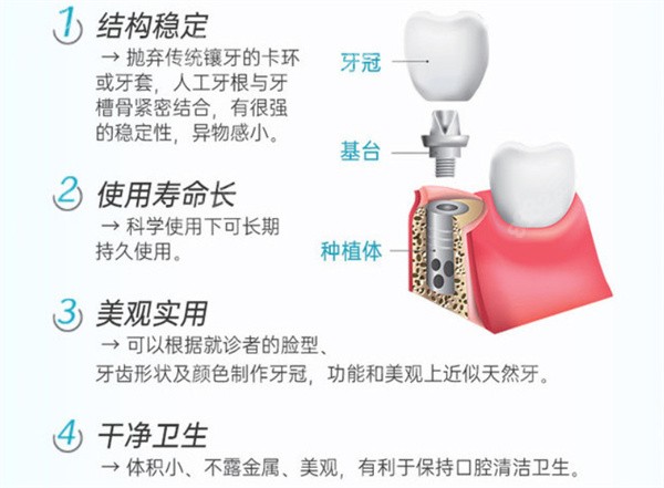 什么是种植牙？优势有哪些？