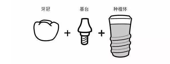 美国种植牙和瑞士种植牙哪个好