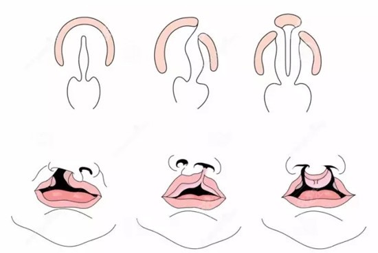 南京哪个医院看唇腭裂比较好