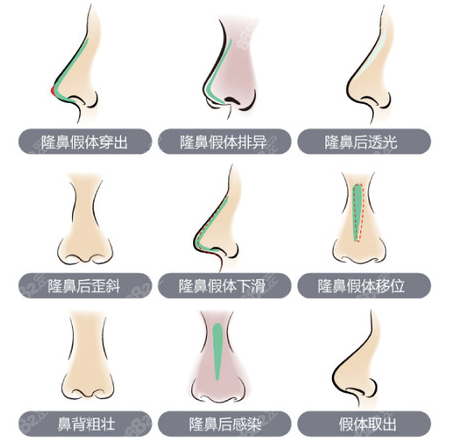 兰州鼻修复医院排名