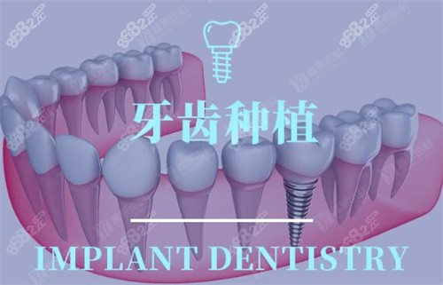 杭州雅莱口腔牙齿种植