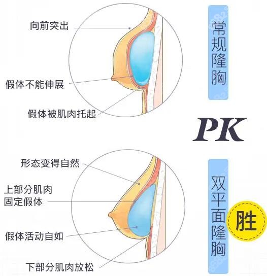 双平面内窥镜隆胸技术优势