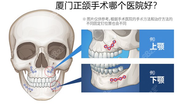 厦门正颌手术哪个医院好