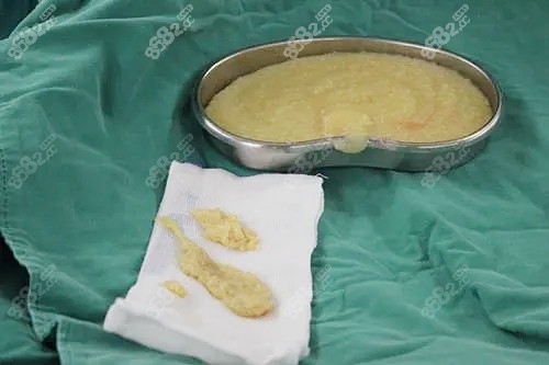 武漢胸部奧美定取出圖片 武漢胸部奧美定取出圖片