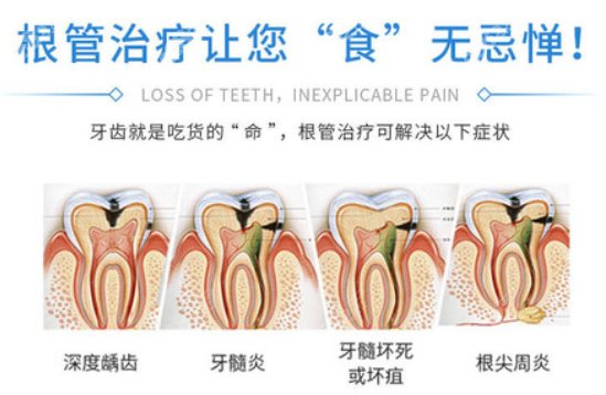 <!--<i data=20240705-sp></i>-->口腔做根管治疗可以解决哪些症状