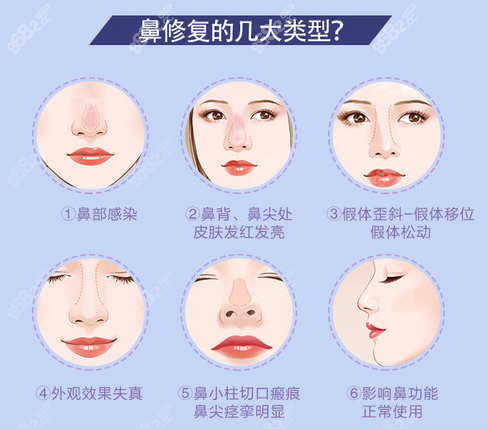 <!--<i data=20240705-sp></i>-->常做的鼻修复类型