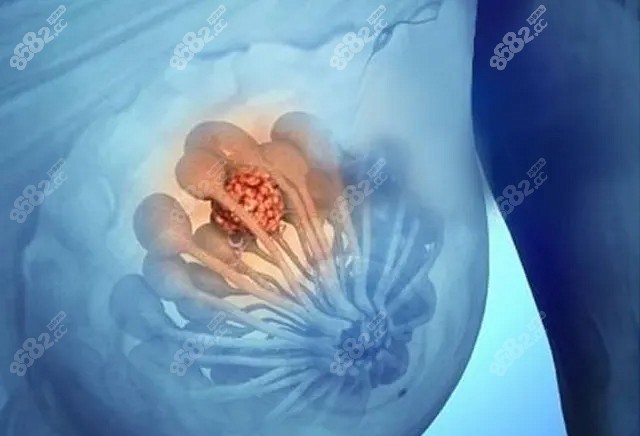 武漢壹加壹整形胸部奧美定取出技術(shù) 武漢壹加壹整形胸部奧美定取出技術(shù)