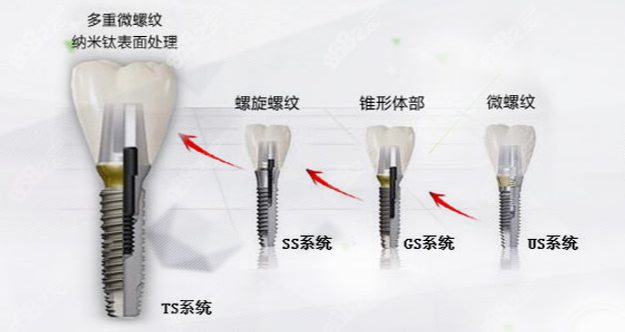 奥齿泰种植牙型号区别图示