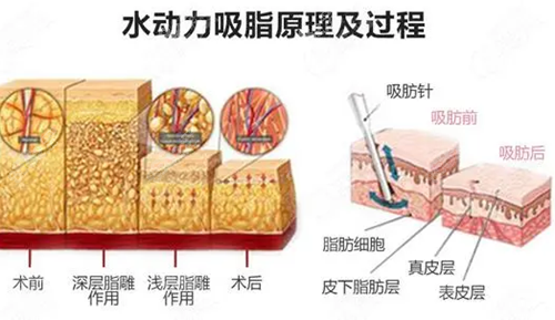 全身吸脂价格多少钱