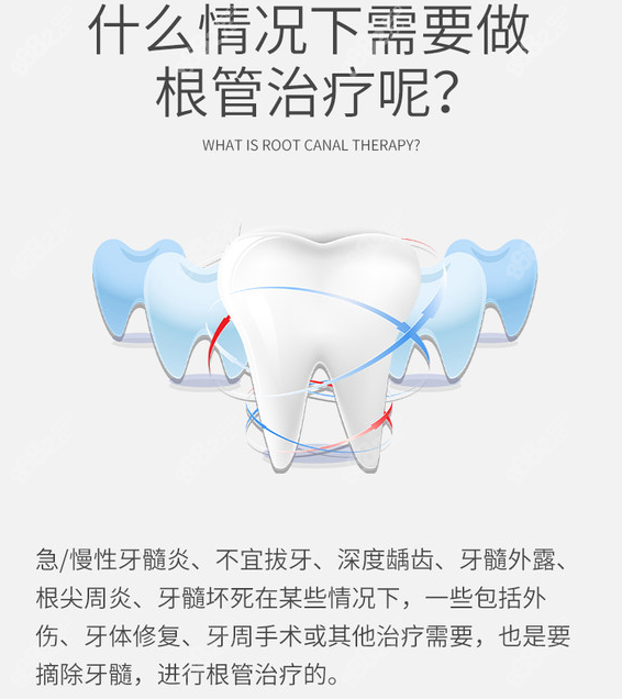 南宁诺贝尔口腔做根管治疗的类型