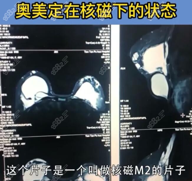 奥美定在核磁下的样子