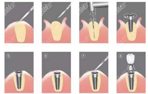 济宁邹城市安琪口腔门诊部种植牙流程